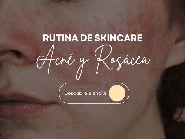 Rutina de Skincare para Acné y Rosácea